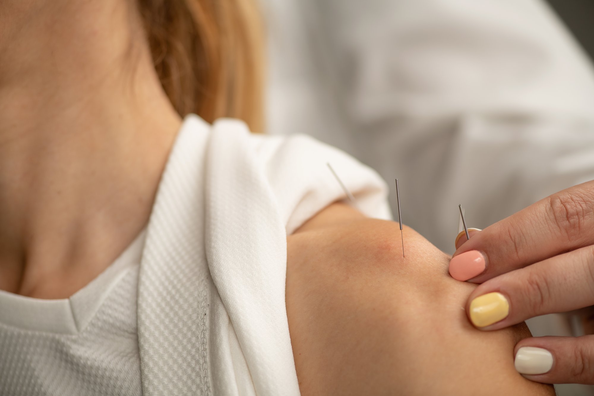 acupuncture-treatment-for-shoulder-pain-and-rotato-2024-10-18-17-56-37-utc