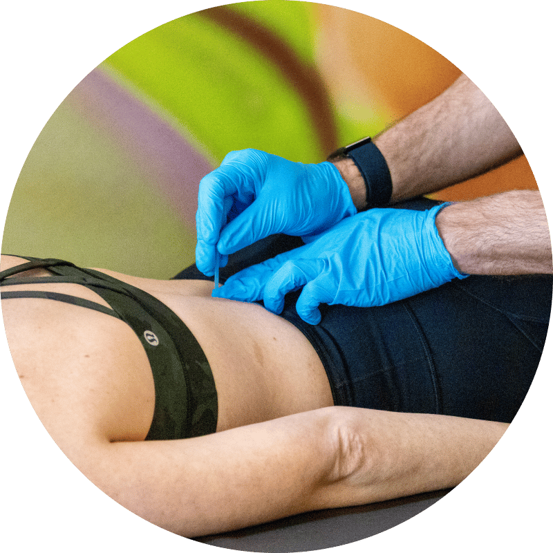 dry-needling