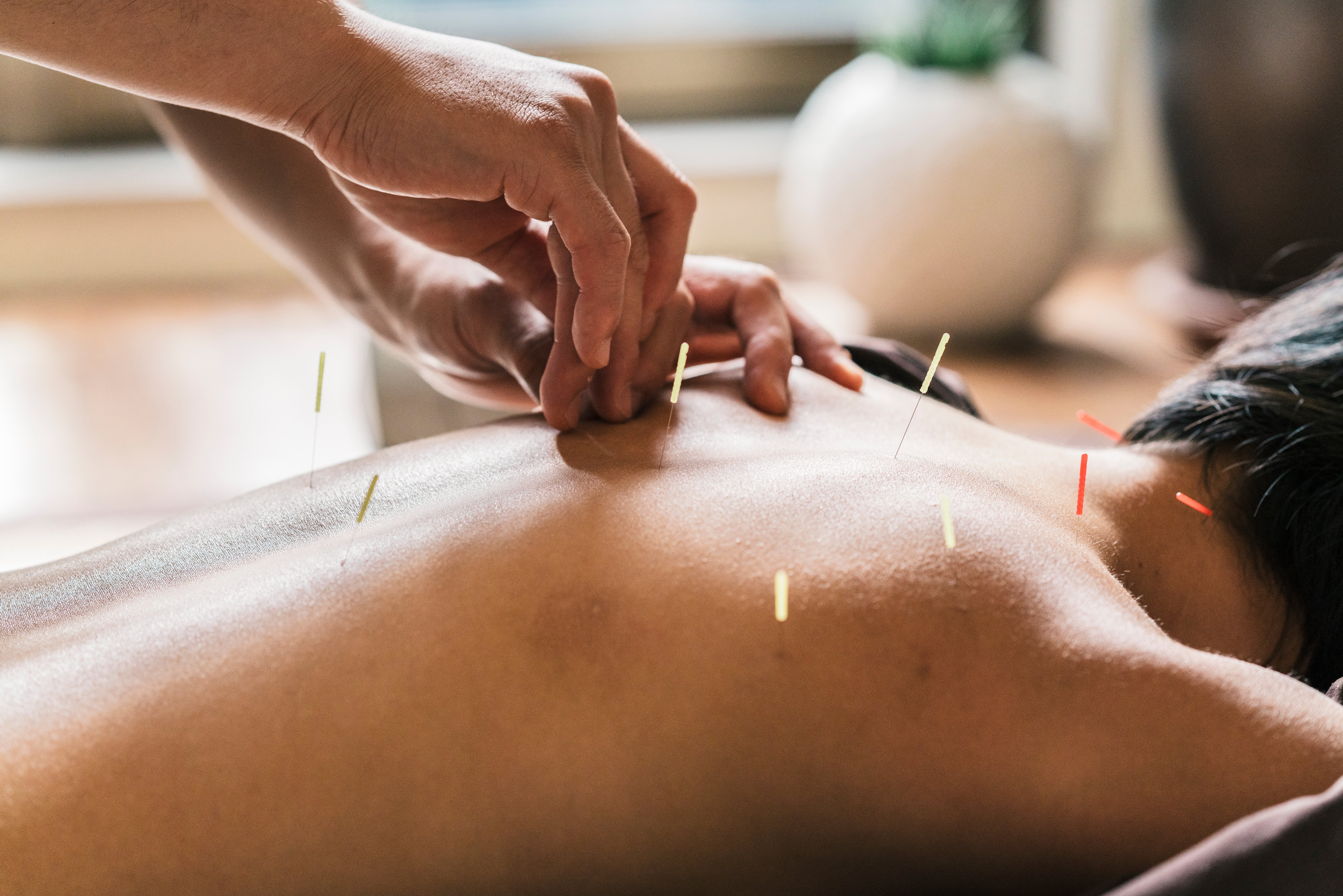 therapist-giving-cupping-treatment-to-young-asian-2024-09-23-05-59-22-utc